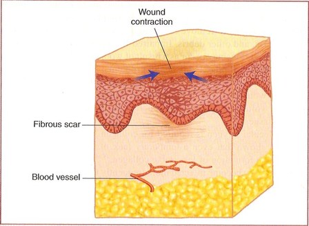 Scar Tissue